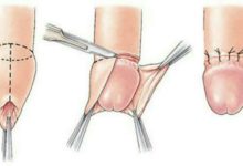 تضيق القلفة