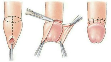 تضيق القلفة