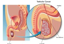 سرطان الخلايا المنتشة