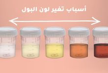 تغير لون البول